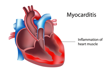 myocarditis